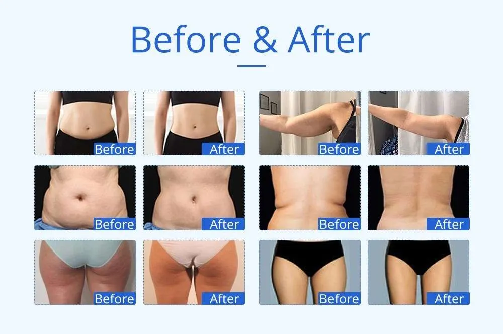 Exquisite 6in1 Ultrasonic Fat & Cellulite Burner, Anti Aging